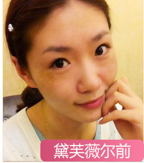 怎樣正確的祛斑?一招教你怎么有效的祛除色斑