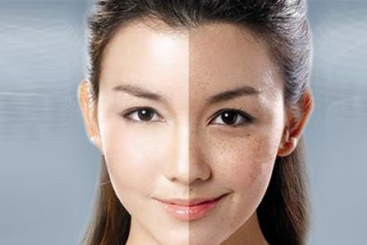 　產(chǎn)后臉上的斑如何淡化 產(chǎn)后如何祛斑小竅門大揭秘