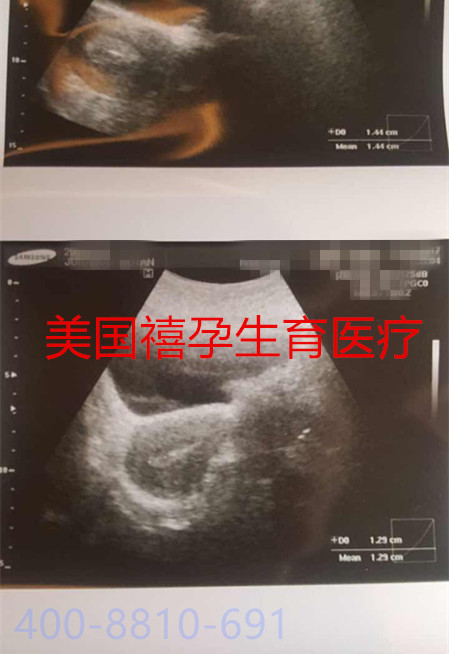 禧孕HRC美國(guó)試管嬰兒的大齡女性-赴美試管前該做什么？
