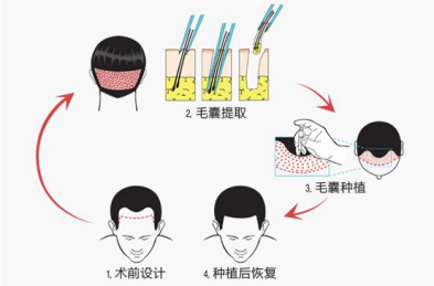 如何選擇植發(fā)醫(yī)院？杭州新生植發(fā)醫(yī)院專家權(quán)威解讀！