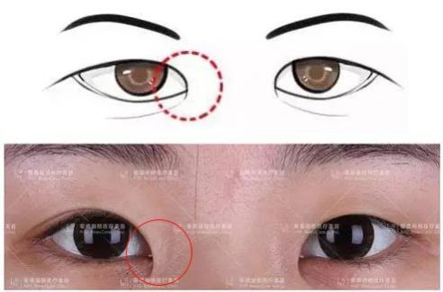 愛德麗格劉志剛小講堂(四)：內(nèi)眥贅皮與開眼角的5毛錢關(guān)系