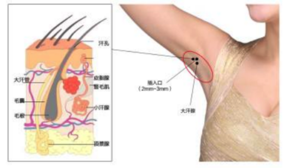 風(fēng)油精治療狐臭，老司機(jī)盤點(diǎn)治療狐臭的小偏方！