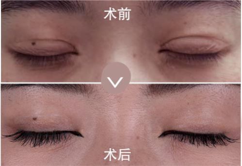 愛德麗格劉志剛小講堂（六）：雙眼皮閉眼有疤，怎么破？