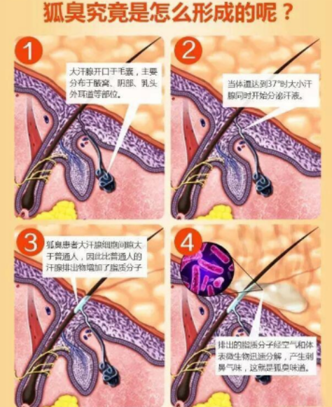 腋下狐臭知多少 告訴你哪些方法去腋臭最佳