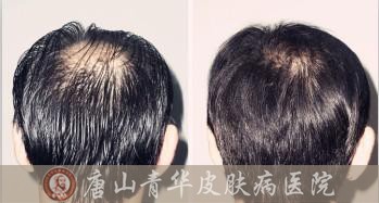 唐山專家講述溢性脫發(fā)的原因有哪些
