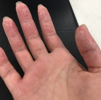 手癬怎么治才能去根？這些事項(xiàng)一定要注意