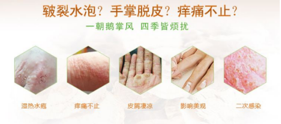 水皰鱗屑手癬真可怕  這種治療方法您知道嗎？