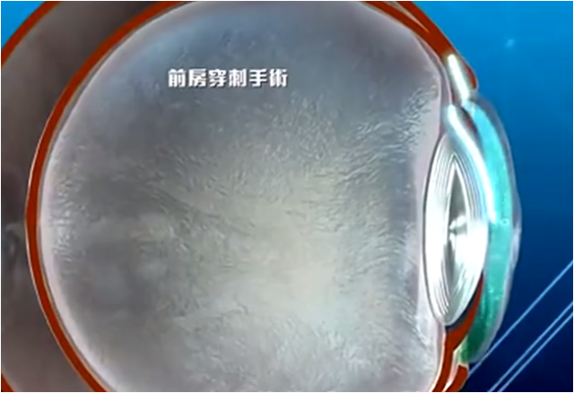 林順潮首創(chuàng)了領(lǐng)先世界的前房穿刺手術(shù)